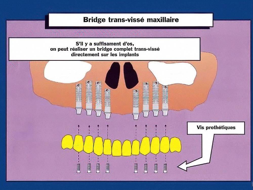 Bridge complet transvissé maxillaire directement sur implants